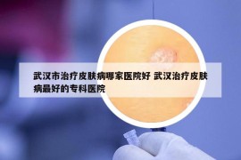武汉市治疗皮肤病哪家医院好 武汉治疗皮肤病最好的专科医院