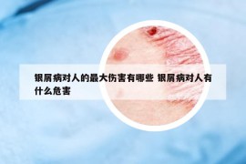 银屑病对人的最大伤害有哪些 银屑病对人有什么危害