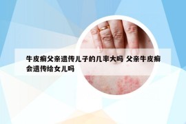 牛皮癣父亲遗传儿子的几率大吗 父亲牛皮癣会遗传给女儿吗