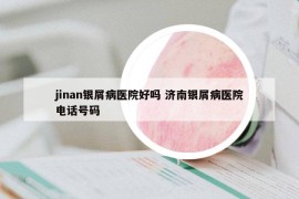 jinan银屑病医院好吗 济南银屑病医院电话号码