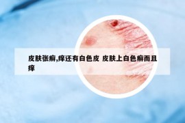 皮肤张癣,痒还有白色皮 皮肤上白色癣而且痒