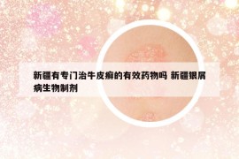 新疆有专门治牛皮癣的有效药物吗 新疆银屑病生物制剂