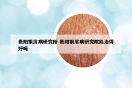 贵阳银屑病研究所 贵阳银屑病研究院能治得好吗