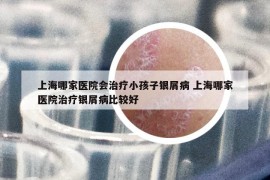 上海哪家医院会治疗小孩子银屑病 上海哪家医院治疗银屑病比较好