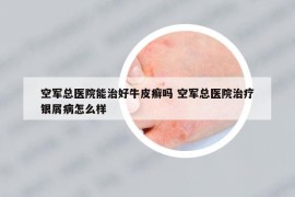 空军总医院能治好牛皮癣吗 空军总医院治疗银屑病怎么样