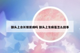 额头上会长银屑病吗 额头上生癣是怎么回事