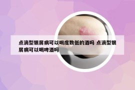点滴型银屑病可以喝度数低的酒吗 点滴型银屑病可以喝啤酒吗