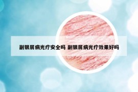 副银屑病光疗安全吗 副银屑病光疗效果好吗