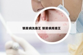银屑病洗康王 银屑病用康王
