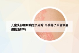 儿童头部银屑病怎么治疗 小孩得了头部银屑病能治好吗