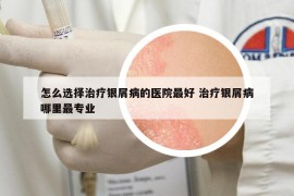 怎么选择治疗银屑病的医院最好 治疗银屑病哪里最专业