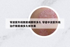 窄波紫外线银屑病要照多久 窄谱中波紫外线治疗银屑病多久有效果