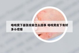 咯吱窝下面张皮藓怎么回事 咯吱窝皮下有好多小疙瘩