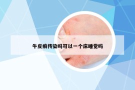 牛皮癣传染吗可以一个床睡觉吗