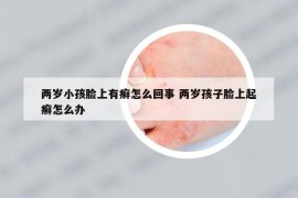 两岁小孩脸上有癣怎么回事 两岁孩子脸上起癣怎么办
