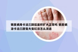 银屑病用卡泊三醇后面积扩大正常吗 银屑病涂卡泊三醇变大变红该怎么消退