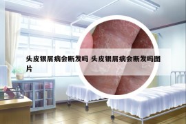头皮银屑病会断发吗 头皮银屑病会断发吗图片