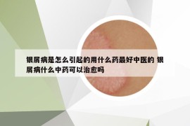 银屑病是怎么引起的用什么药最好中医的 银屑病什么中药可以治愈吗