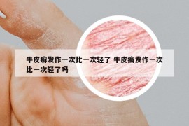 牛皮癣发作一次比一次轻了 牛皮癣发作一次比一次轻了吗