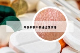 牛皮癣会不会通过性传播