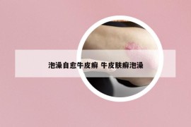 泡澡自愈牛皮癣 牛皮肤癣泡澡