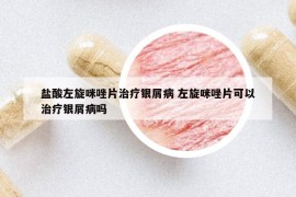 盐酸左旋咪唑片治疗银屑病 左旋咪唑片可以治疗银屑病吗