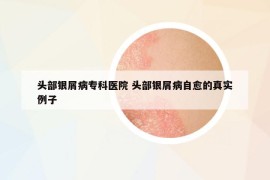 头部银屑病专科医院 头部银屑病自愈的真实例子