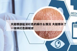 大腿根部起深红色的癣什么情况 大腿根长了一块块红色藓蜕皮