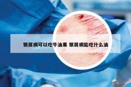 银屑病可以吃牛油果 银屑病能吃什么油