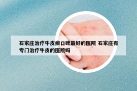 石家庄治疗牛皮癣口碑最好的医院 石家庄有专门治疗牛皮的医院吗