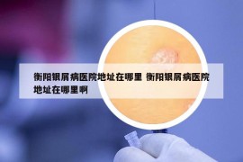 衡阳银屑病医院地址在哪里 衡阳银屑病医院地址在哪里啊
