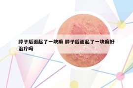 脖子后面起了一块癣 脖子后面起了一块癣好治疗吗