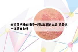 有银屑病痒的时候一抓就出现有血斑 银屑病一抓就出血吗