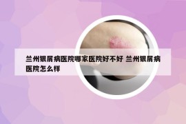 兰州银屑病医院哪家医院好不好 兰州银屑病医院怎么样