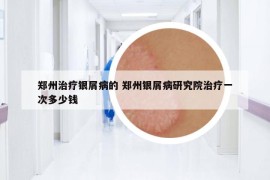 郑州治疗银屑病的 郑州银屑病研究院治疗一次多少钱