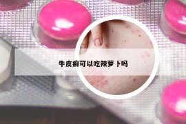 牛皮癣可以吃辣萝卜吗