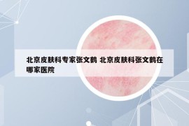 北京皮肤科专家张文鹤 北京皮肤科张文鹤在哪家医院