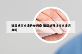 银屑病打点滴丹参阿奇 银屑病可以打点滴消炎吗