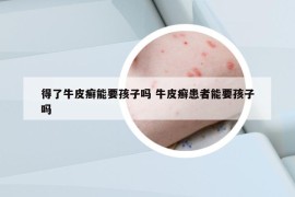 得了牛皮癣能要孩子吗 牛皮癣患者能要孩子吗