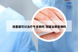 拔重罐可以治疗牛皮癣吗 拔罐治银屑病吗