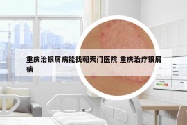 重庆治银屑病能找朝天门医院 重庆治疗银屑病