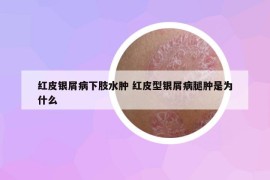红皮银屑病下肢水肿 红皮型银屑病腿肿是为什么