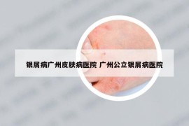 银屑病广州皮肤病医院 广州公立银屑病医院