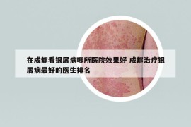 在成都看银屑病哪所医院效果好 成都治疗银屑病最好的医生排名
