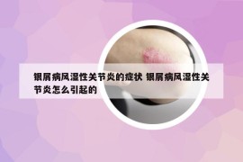 银屑病风湿性关节炎的症状 银屑病风湿性关节炎怎么引起的