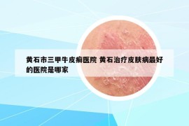 黄石市三甲牛皮癣医院 黄石治疗皮肤病最好的医院是哪家