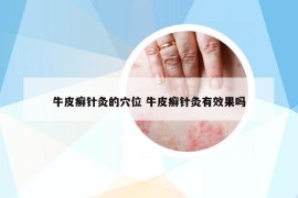 牛皮癣针灸的穴位 牛皮癣针灸有效果吗