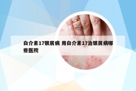 白介素17银屑病 用白介素17治银屑病哪些医院