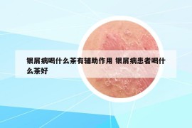 银屑病喝什么茶有辅助作用 银屑病患者喝什么茶好