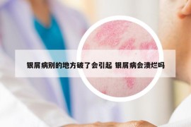 银屑病别的地方破了会引起 银屑病会溃烂吗